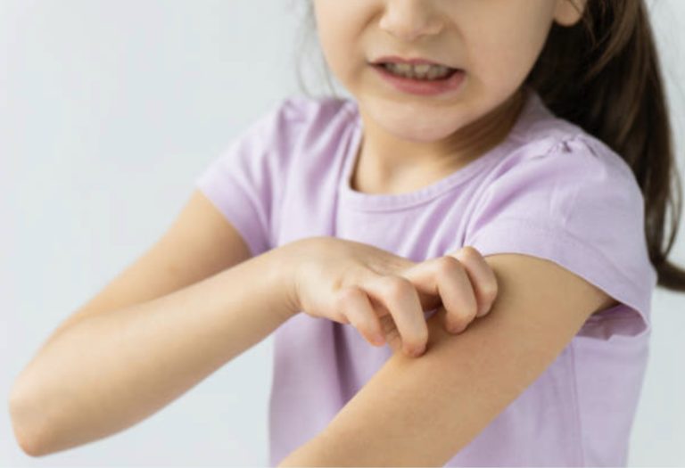  KIŞ ALERJİLERİ NEDİR ?